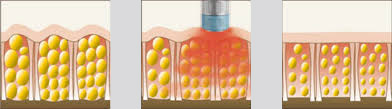 Celulitis