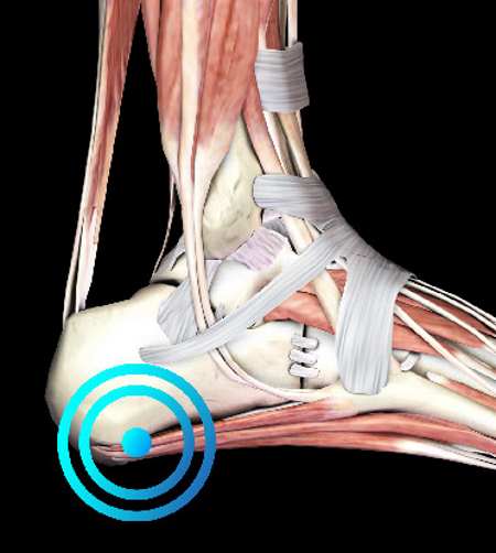fasciopatia plantar