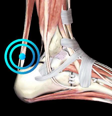 Tendon de Aquiles